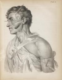 Plate IV from Joseph Pancoast’s "Treatise on Operative Surgery"